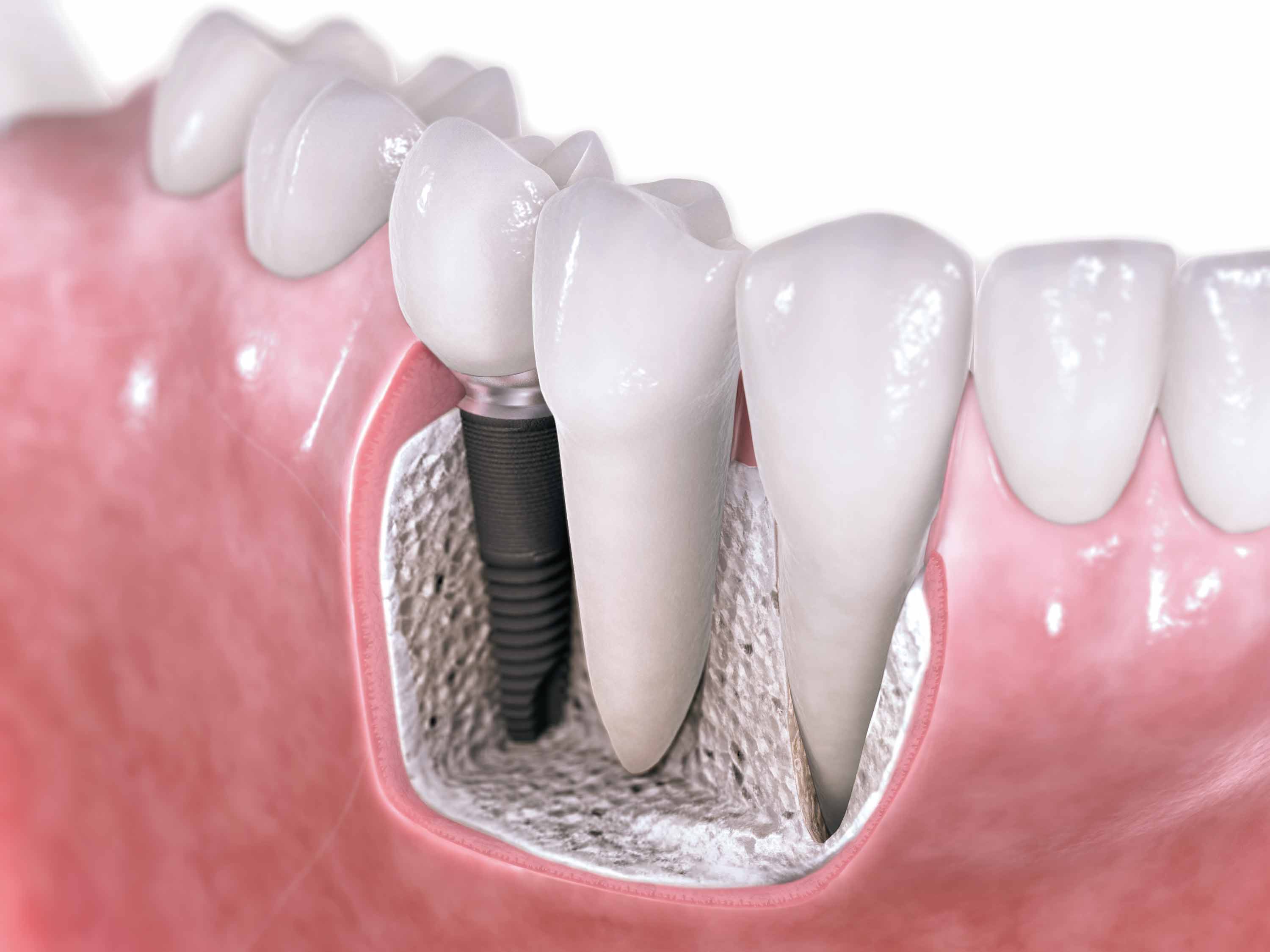 dental implants1